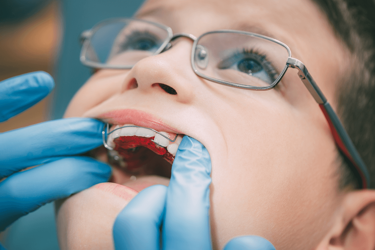 Primo piano di un bambino con gli occhiali mentre un dentista con guanti blu posiziona o controlla un apparecchio ortodontico mobile palatale rosso e metallico.