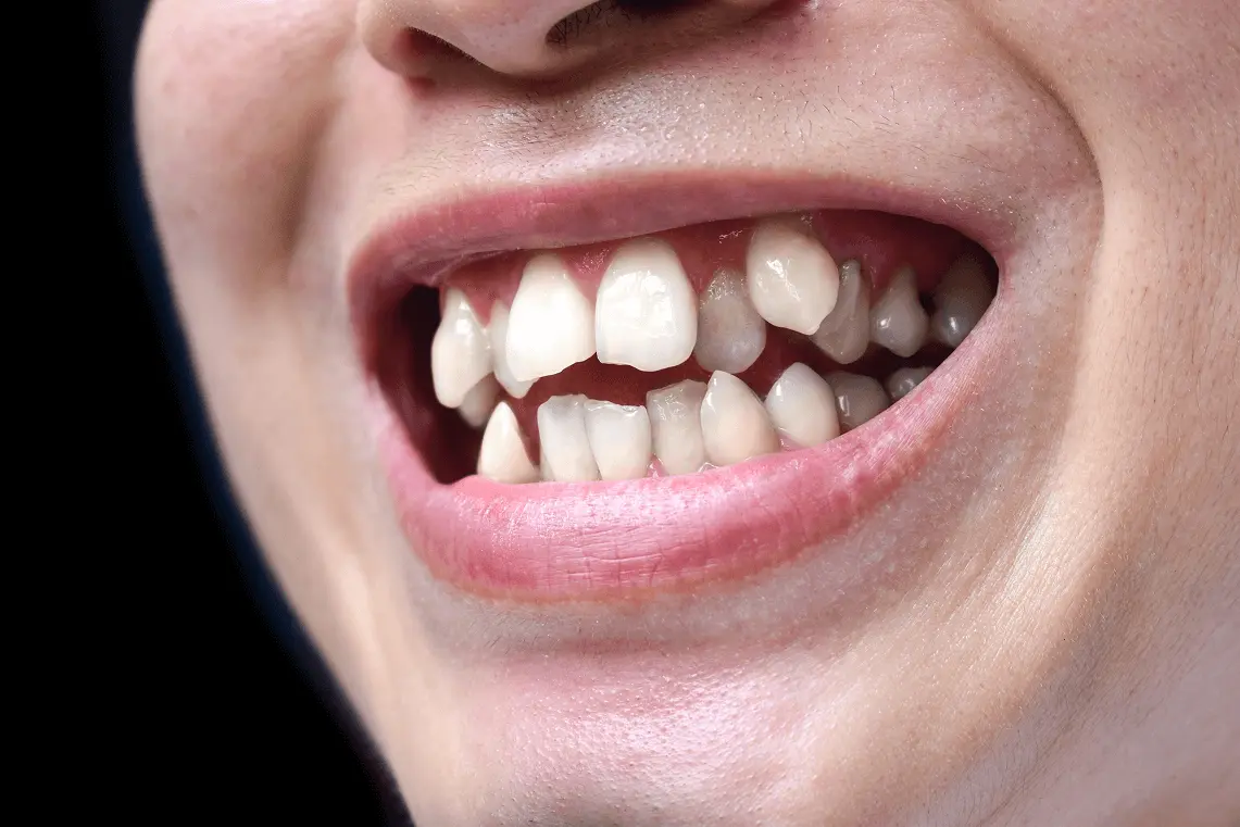 Primo piano di una bocca aperta che mostra denti sovrapposti e disallineati nell'arcata superiore e inferiore.
