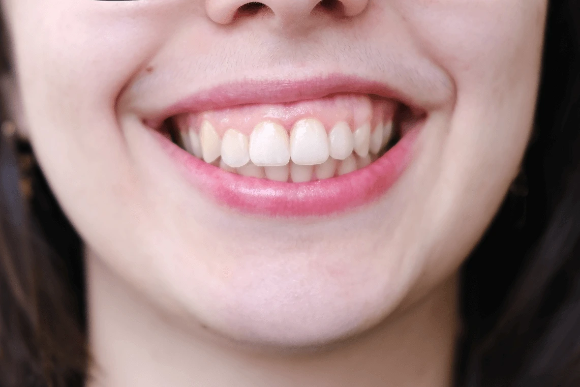 Primo piano del sorriso di una donna con esposizione evidente delle gengive (gummy smile).