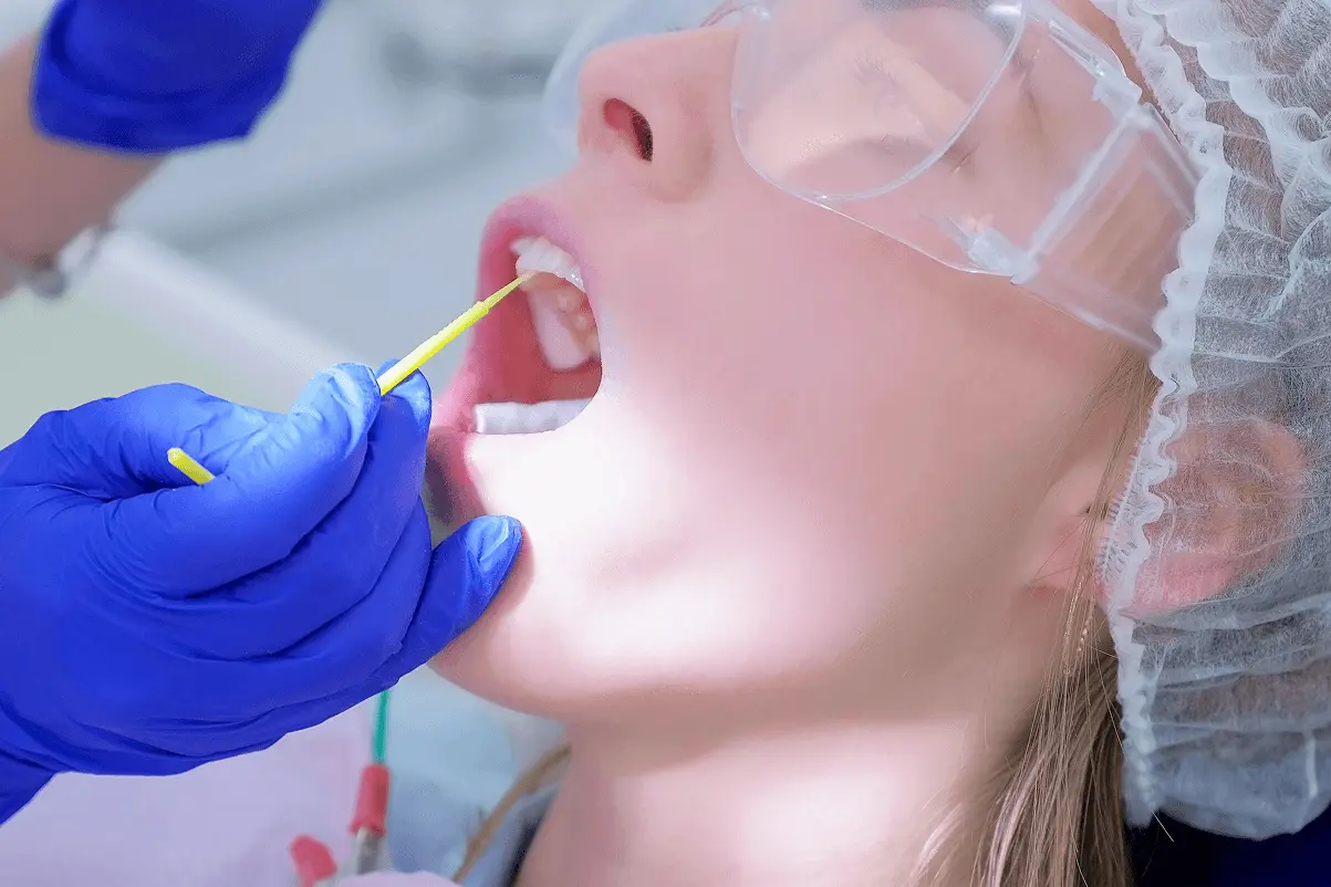 Primo piano del profilo di una paziente con occhiali protettivi e cuffia mentre il dentista applica un prodotto con un microbrush sui denti superiori.