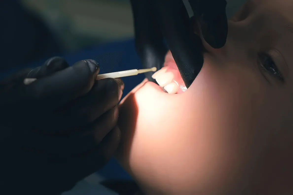 Primo piano di un bambino durante una seduta dentistica mentre un operatore con guanti neri applica un gel o sigillante sui denti con un pennellino microbrush.