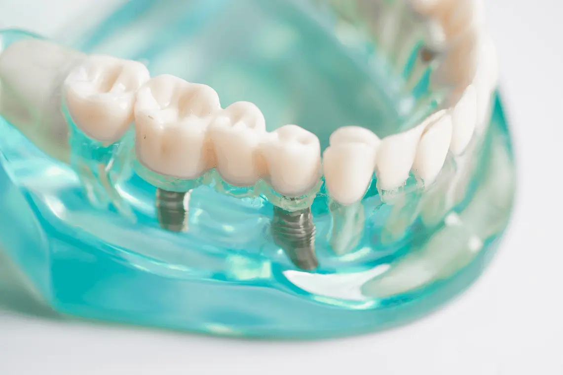 Primo piano di un modello anatomico in resina trasparente azzurra che mostra le viti degli impianti dentali inserite nell'osso e la protesi con ponte.
