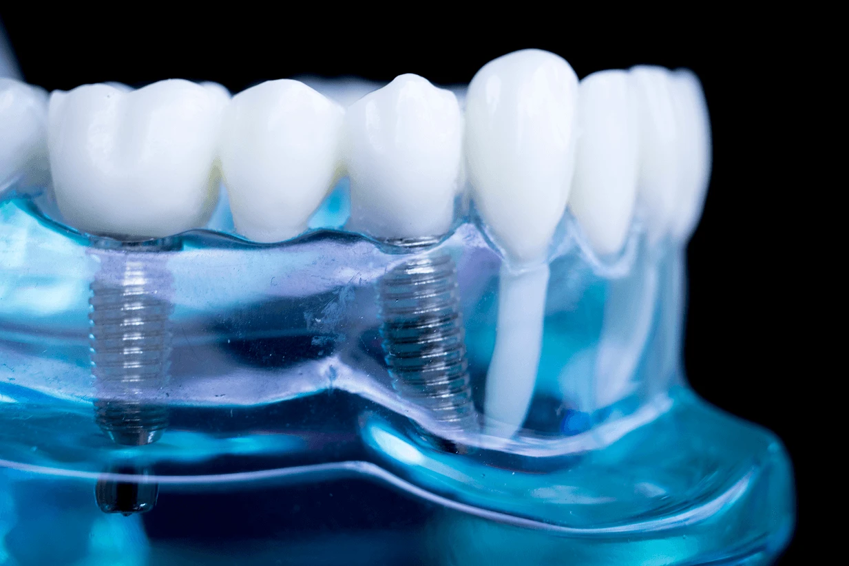 Modello anatomico trasparente che mostra le viti degli impianti dentali in titanio inserite nell'osso a confronto con una radice dentale naturale.
