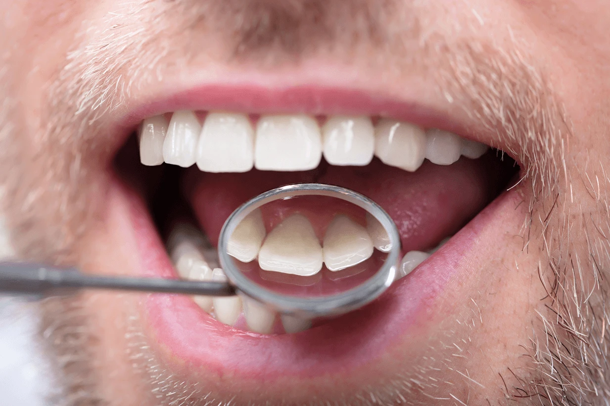 Primo piano del sorriso di un paziente uomo mentre il dentista utilizza uno specchietto da visita per ispezionare la parete interna dei denti incisivi.
