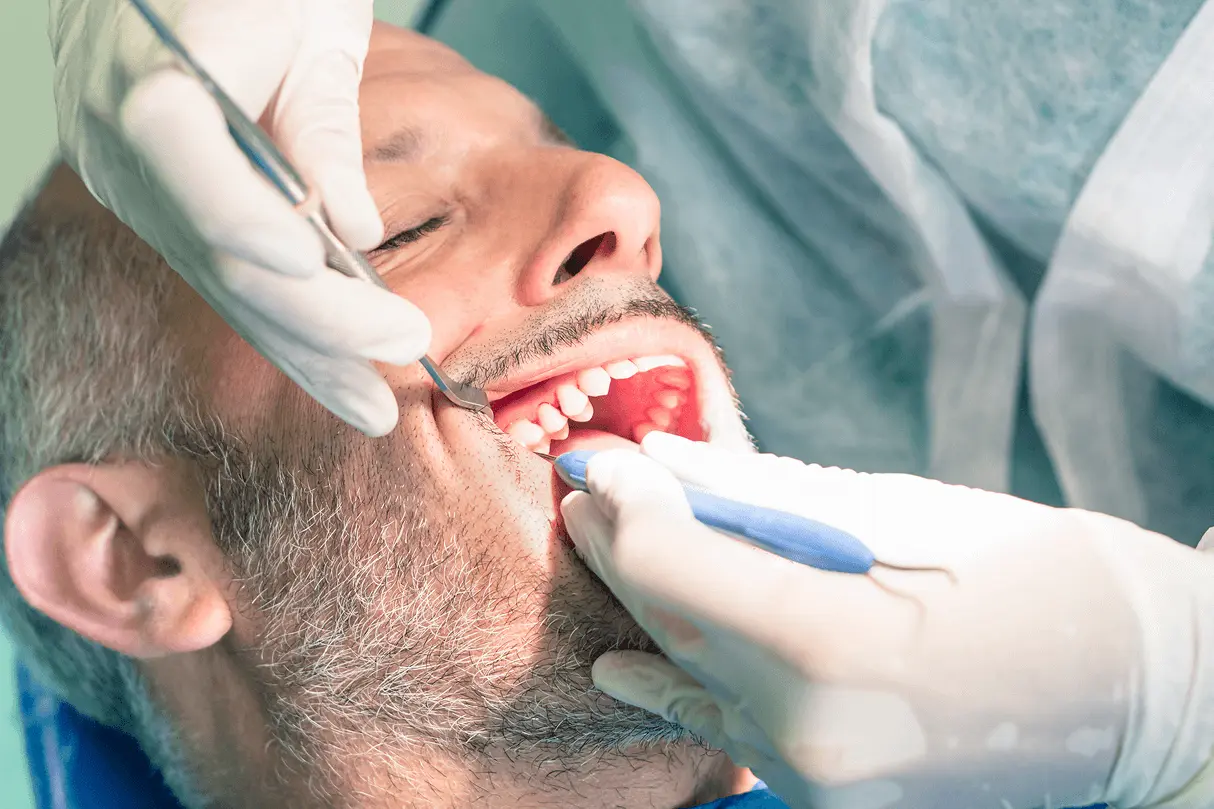 Odontoiatra con guanti bianchi che effettua un controllo meticoloso e una pulizia dei denti professionale su un paziente uomo.