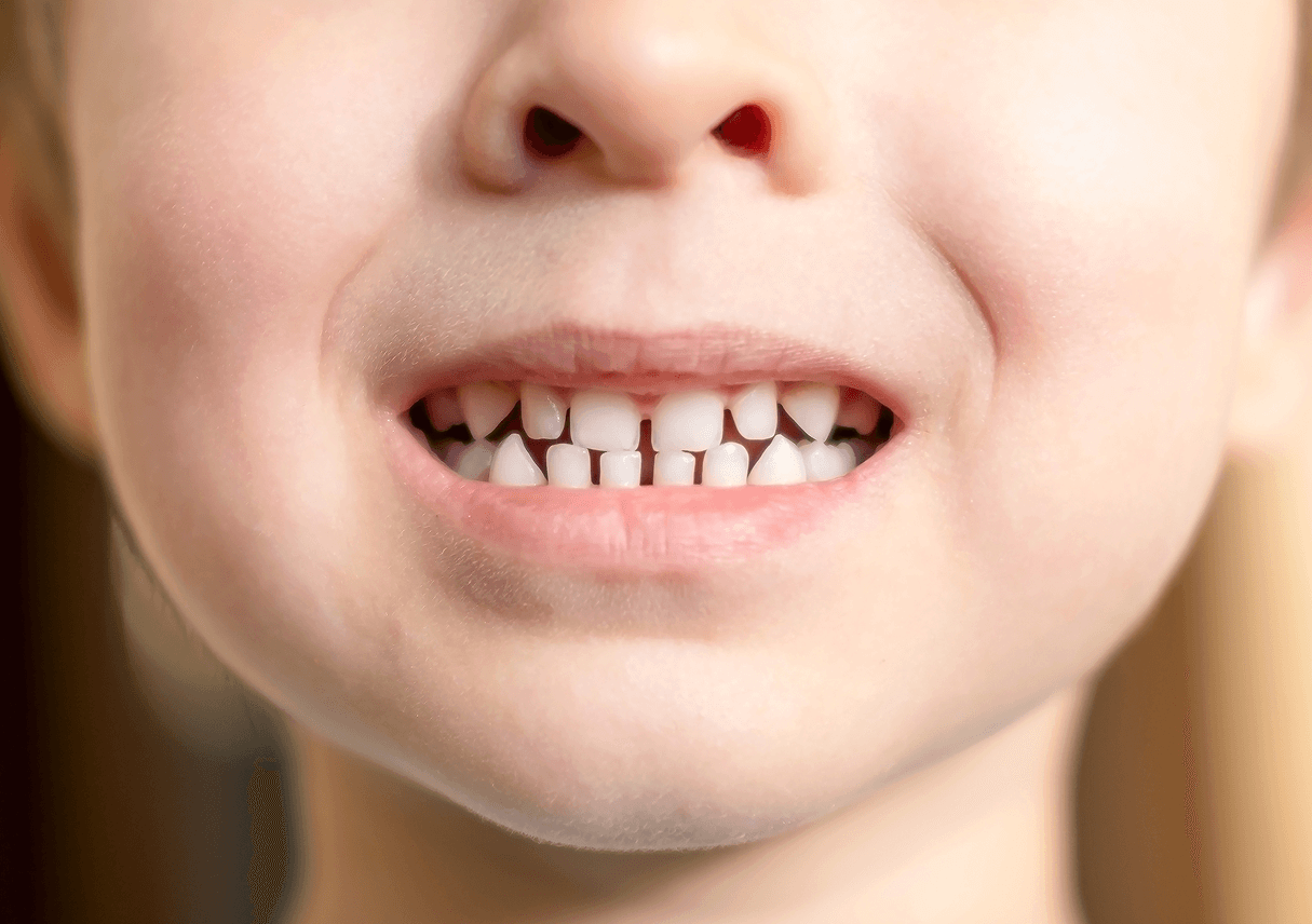 Macro in primo piano della bocca e del sorriso di un bambino che mostra i denti da latte ben distanziati.