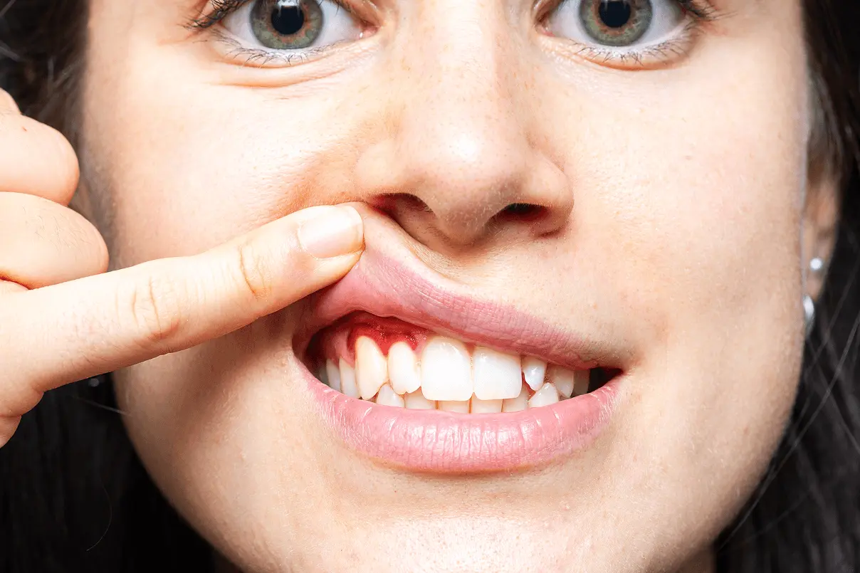 Primo piano del viso di una donna che solleva il labbro superiore con un dito per mostrare il sanguinamento e l'infiammazione delle gengive attorno ai denti.