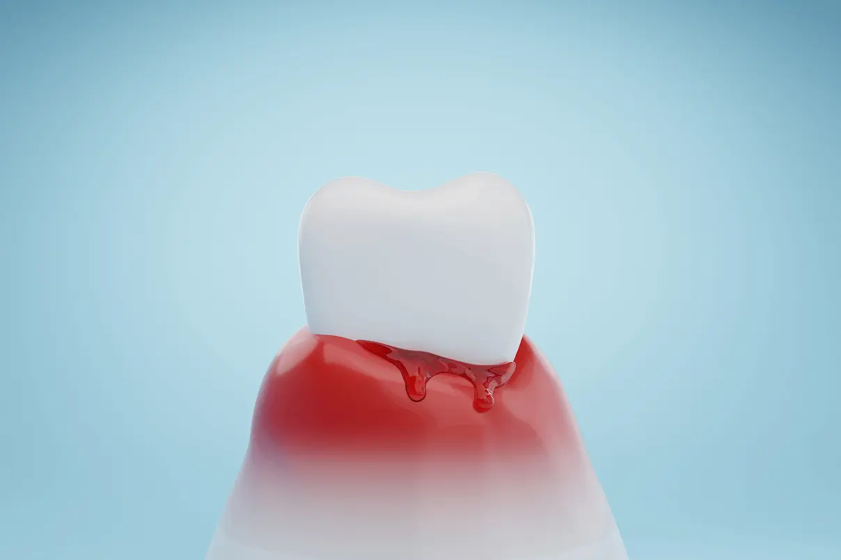 Rendering grafico 3D di un dente bianco con gengiva arrossata e gocce di sangue alla base sul colletto dentale, su sfondo azzurro.