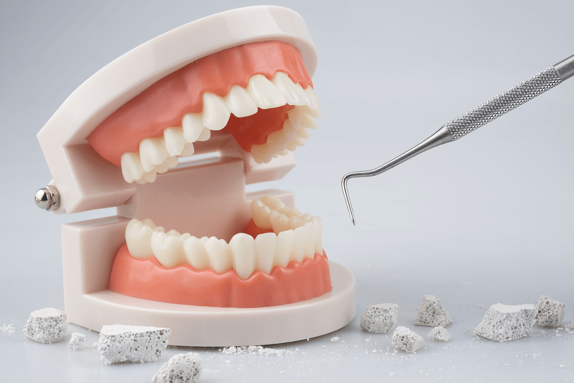Modello anatomico di dentiera con strumento per ablazione del tartaro e frammenti minerali alla base.