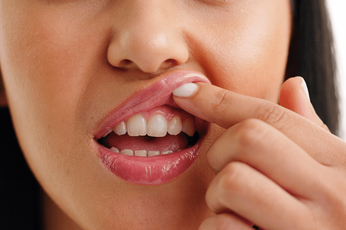 Primo piano di una donna che solleva leggermente il labbro superiore con un dito per mostrare le gengive e i denti superiori.