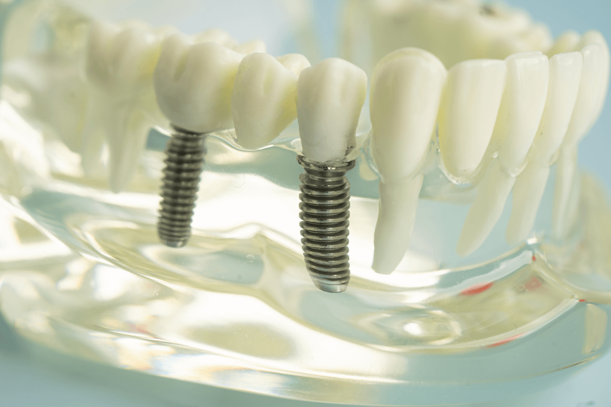 Dettaglio di un modello trasparente dell'arcata dentale che mostra due viti di impianti dentali in titanio inserite nell'osso a confronto con le radici naturali.