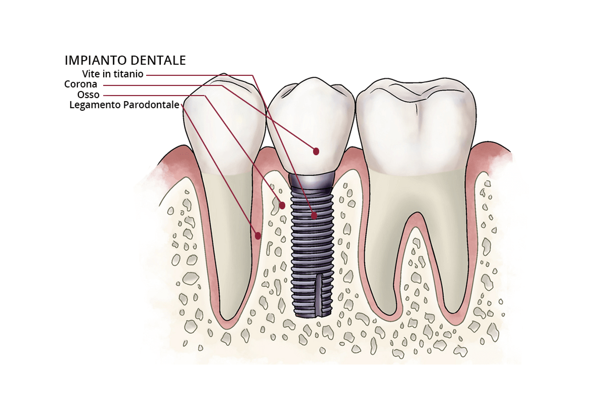 Illustrazione anatomica che mostra un impianto dentale tra due denti naturali, con etichette per vite in titanio, corona, osso e legamento parodontale.
