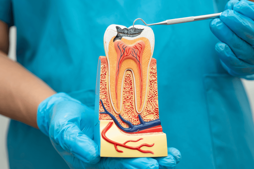 Dettaglio di un modello dimostrativo in sezione che illustra la penetrazione di una carie attraverso smalto, dentina e la struttura interna del dente.