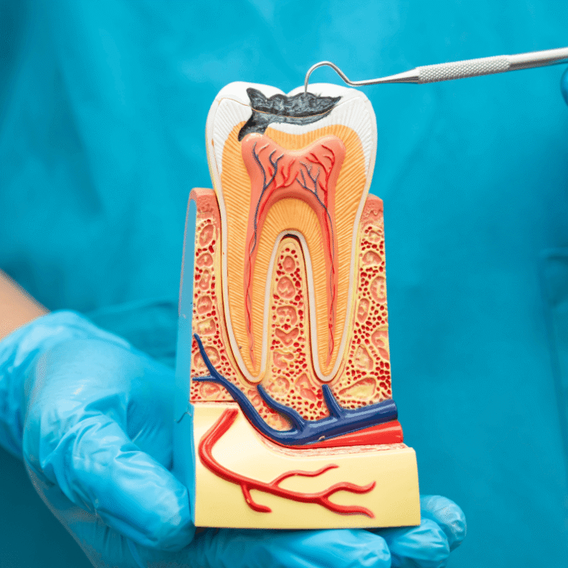 Dettaglio di un modello dimostrativo in sezione che illustra la penetrazione di una carie attraverso smalto, dentina e la struttura interna del dente.