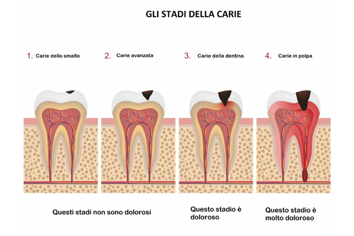 Grafico illustrato sui quattro stadi della carie: dalla superficie dello smalto alla dentina fino alla polpa, con indicazione del livello di dolore.