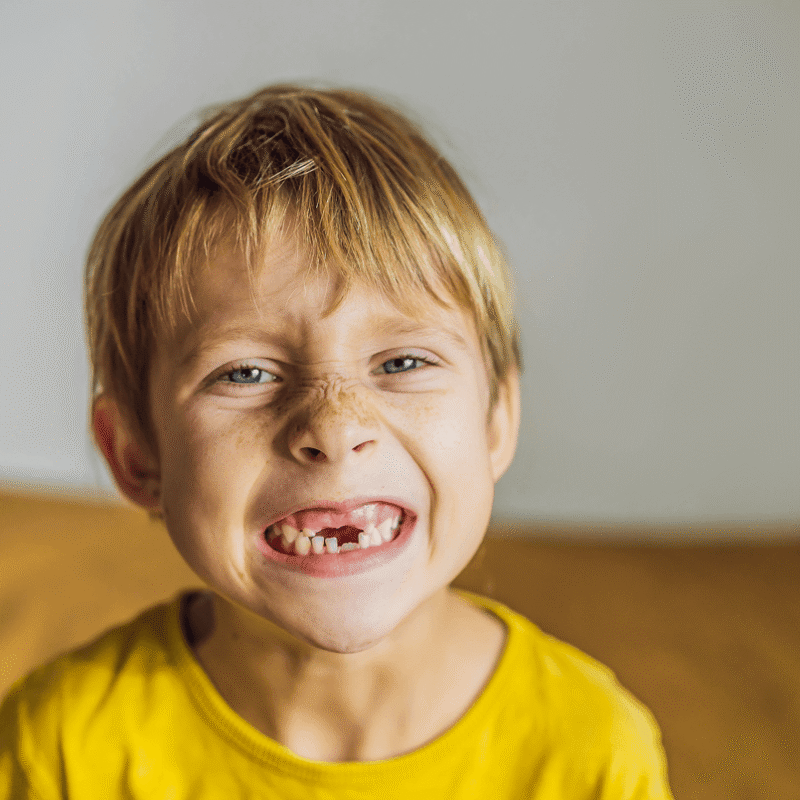 Primo piano di un bambino biondo con maglietta gialla che fa una smorfia sorridente mostrando la finestra lasciata dalla caduta di un dente da latte.