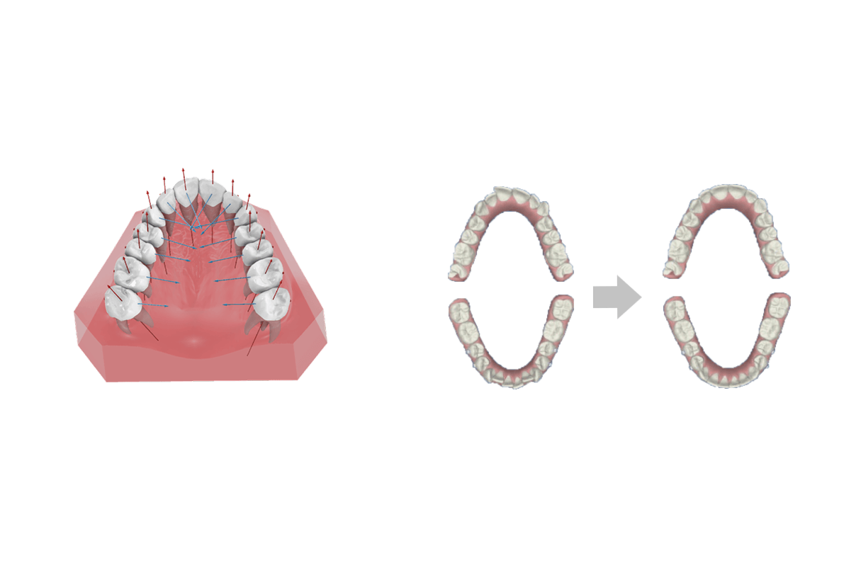 Simulazione ortodontica 3D che mostra i vettori delle forze sui denti a sinistra e la progressione del riallineamento dell'arcata prima e dopo a destra.