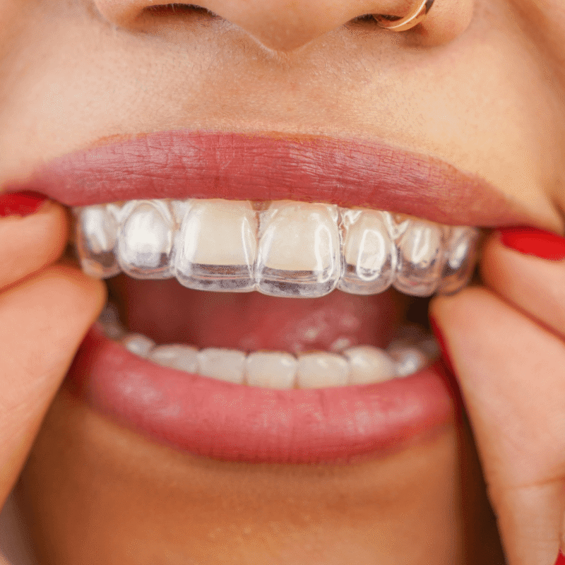 Primo piano delle labbra e delle mani di una donna che indossa o rimuove una mascherina trasparente per l'ortodonzia invisibile sull'arcata superiore.