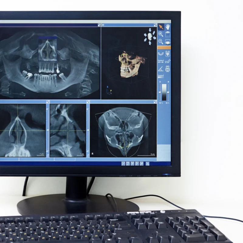 Monitor del computer che mostra una ricostruzione tridimensionale 3D delle arcate dentali e del cranio per la diagnosi odontoiatrica.
