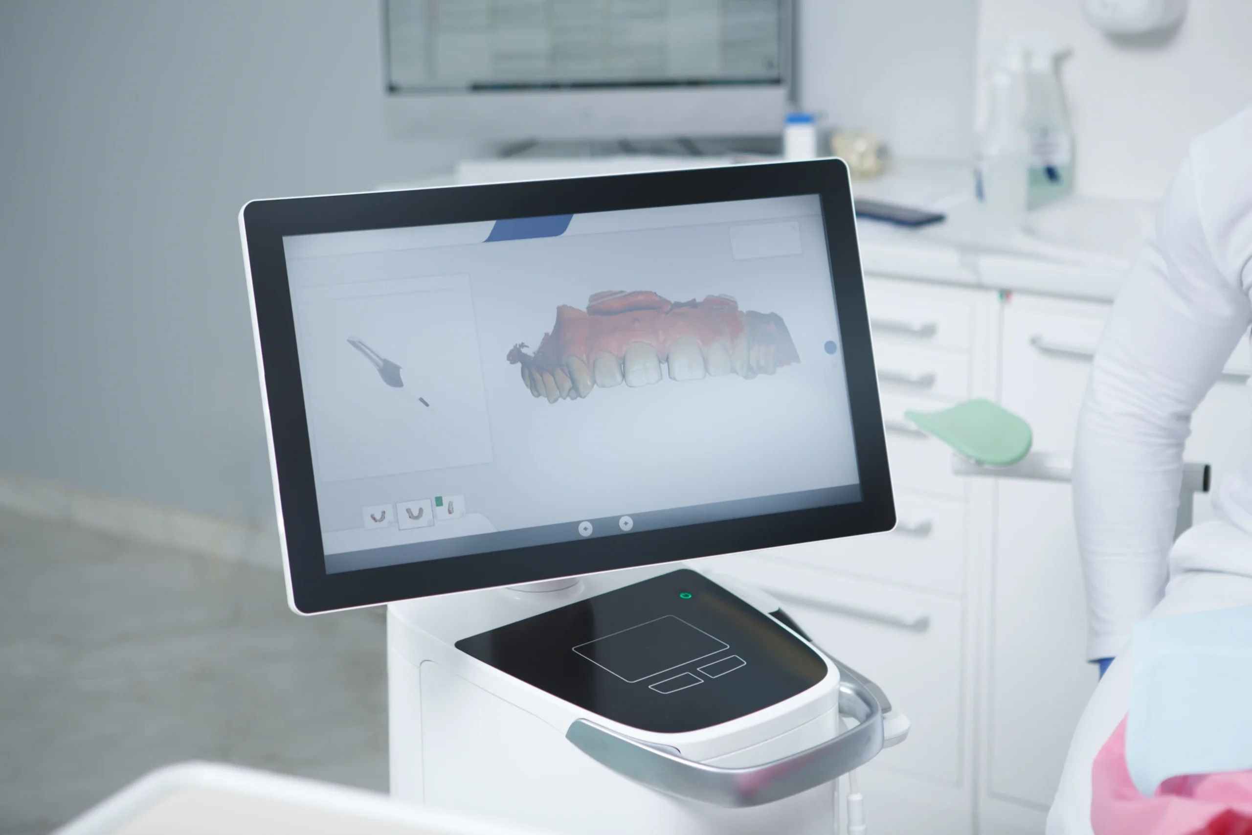 Impronte digitali con scanner intraorale