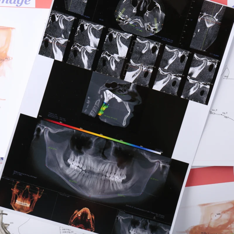Stampe diagnostiche con radiografie tridimensionali, ortopanoramica e tracciato cefalometrico per pianificazione ortodontica.