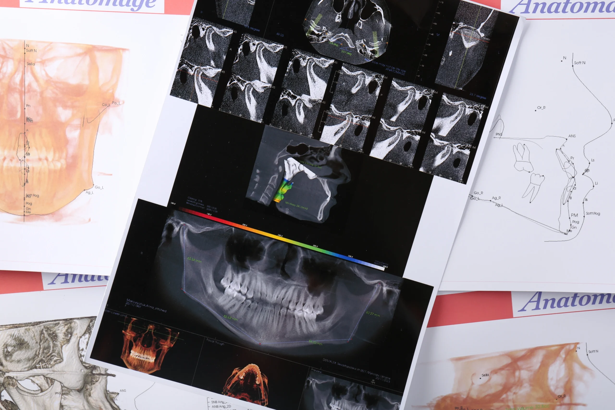 Radiologia digitale 3D a basso dosaggio