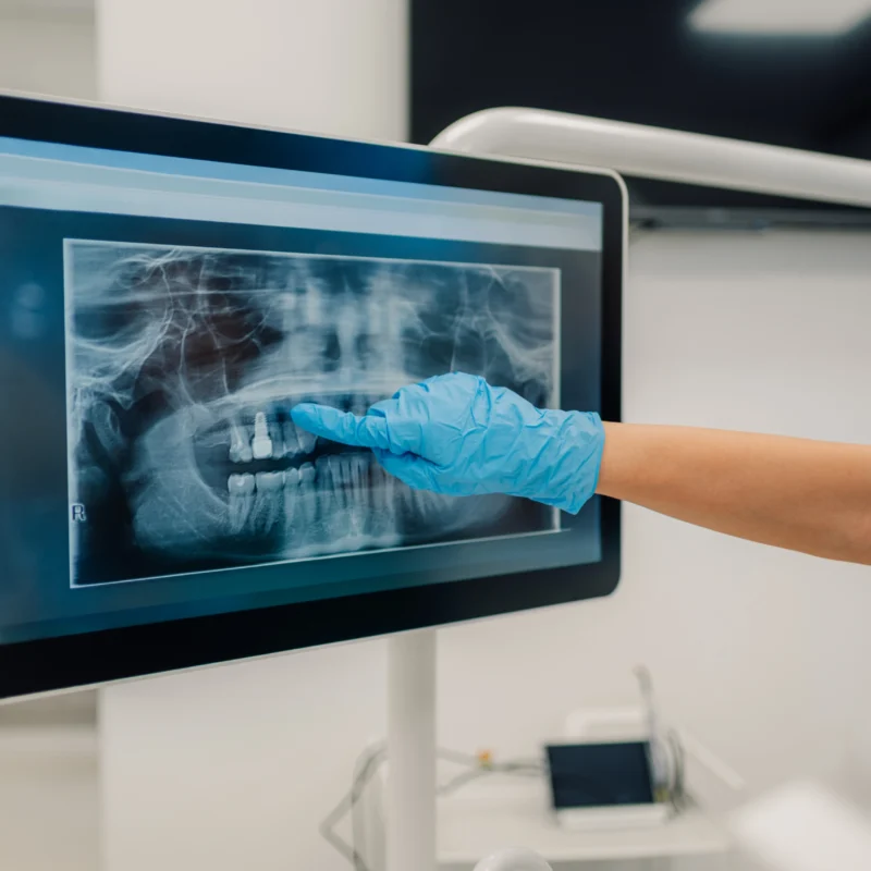 Mano con guanto medico azzurro che indica un impianto dentale su una radiografia panoramica digitale a monitor.