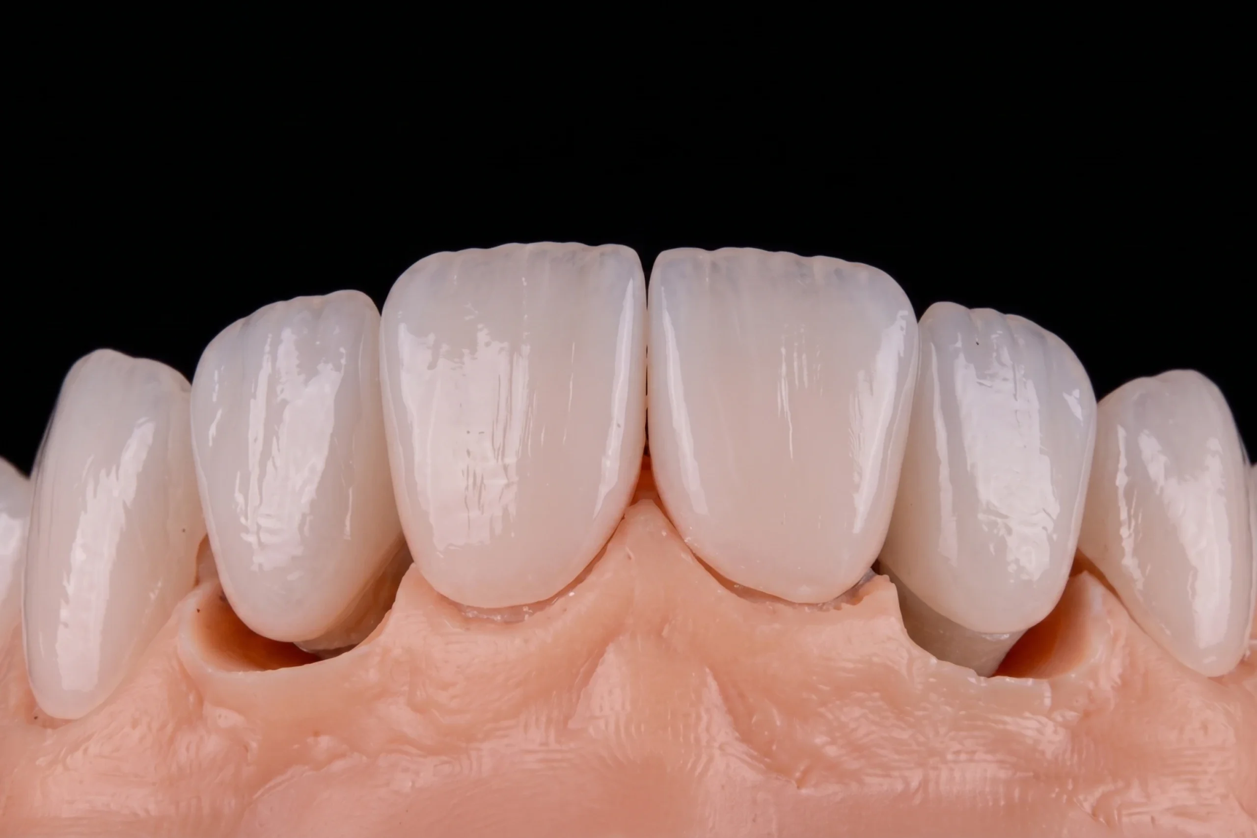 Primo piano di faccette dentali in ceramica ad altissima naturalezza e traslucenza posizionate su un modello di protesi con gengiva rosa.