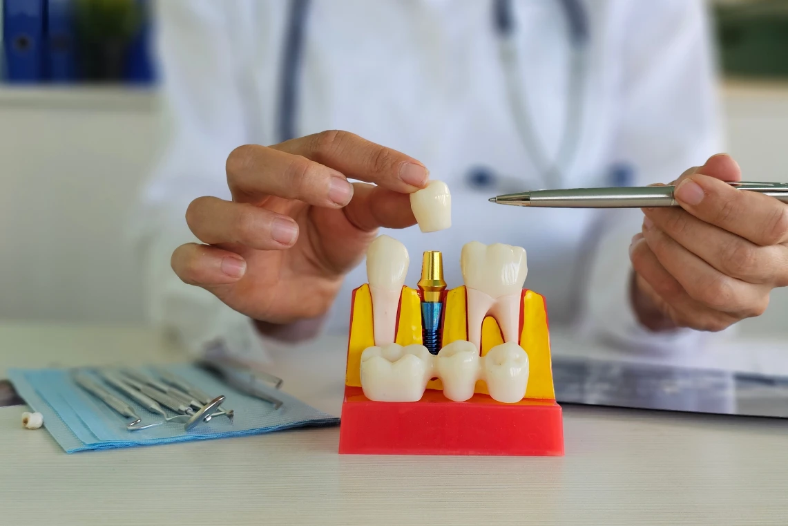 Mani di un dentista alla scrivania mentre posizionano una corona in ceramica sul moncone dorato di un impianto dentale inserito nel modello anatomico.