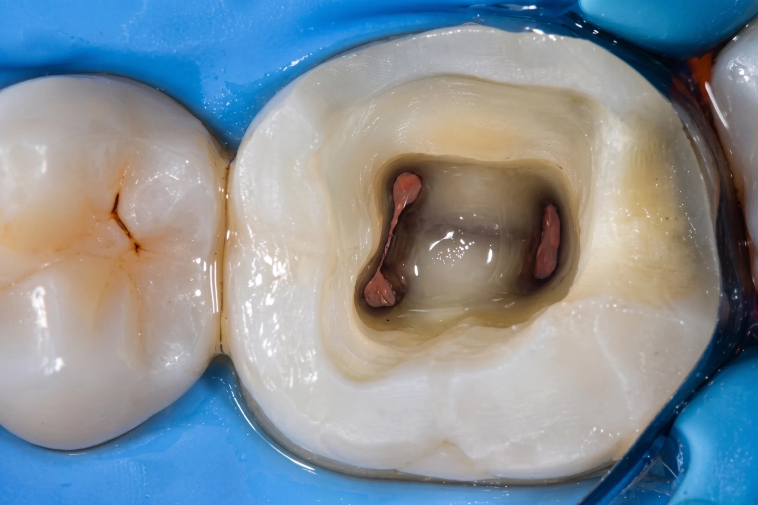 Vista occlusale in macro di un dente molare devitalizzato isolato con diga di gomma blu, con canali radicolari sigillati in guttaperca rosa prima della ricostruzione.