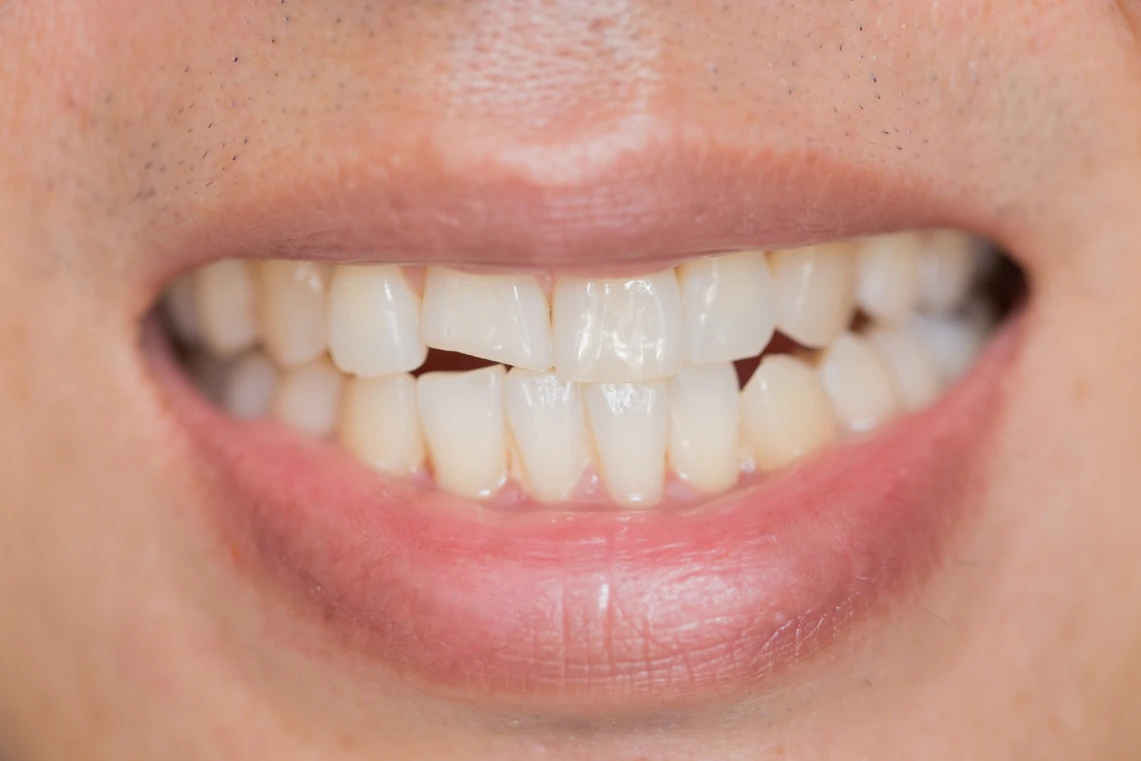 Primo piano del sorriso di un uomo con un incisivo centrale superiore scheggiato e parzialmente rotto.
