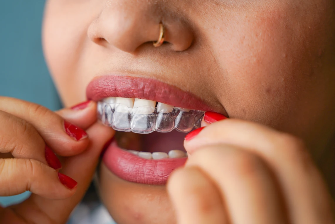 Primo piano di una donna che indossa un allineatore dentale trasparente sull'arcata superiore.