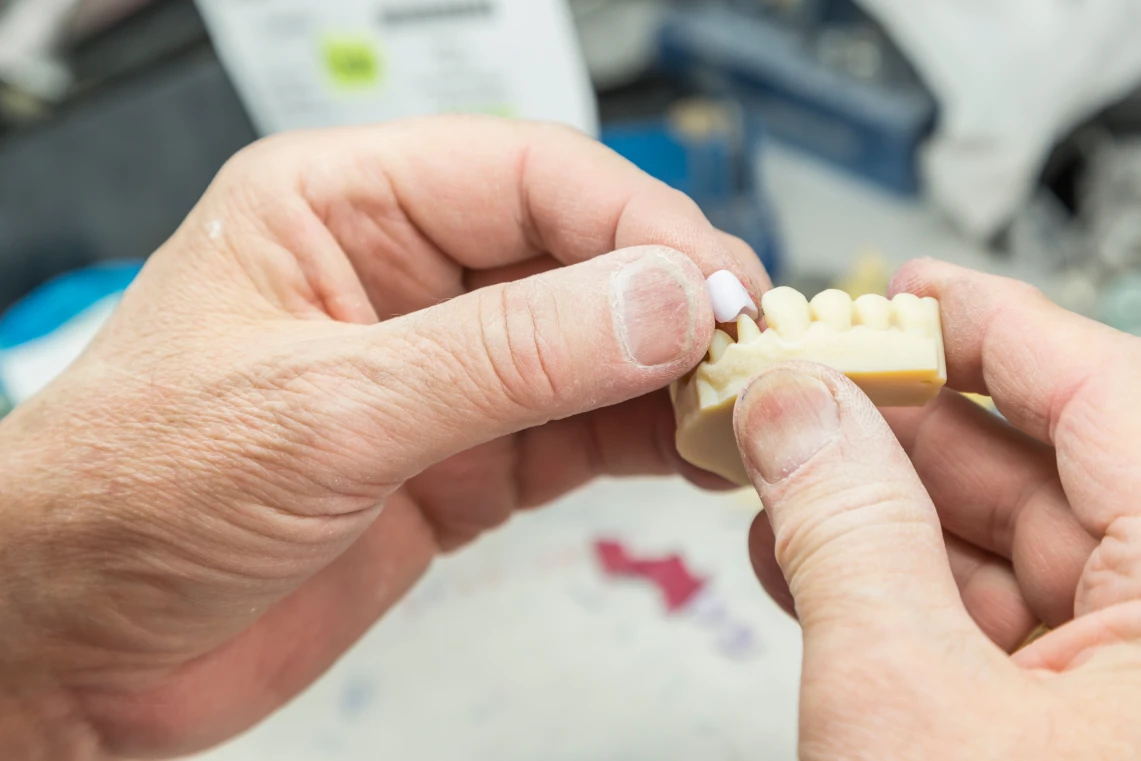 Mani di un odontotecnico che posizionano una corona dentale in ceramica su un calco in gesso dell'arcata dentale.