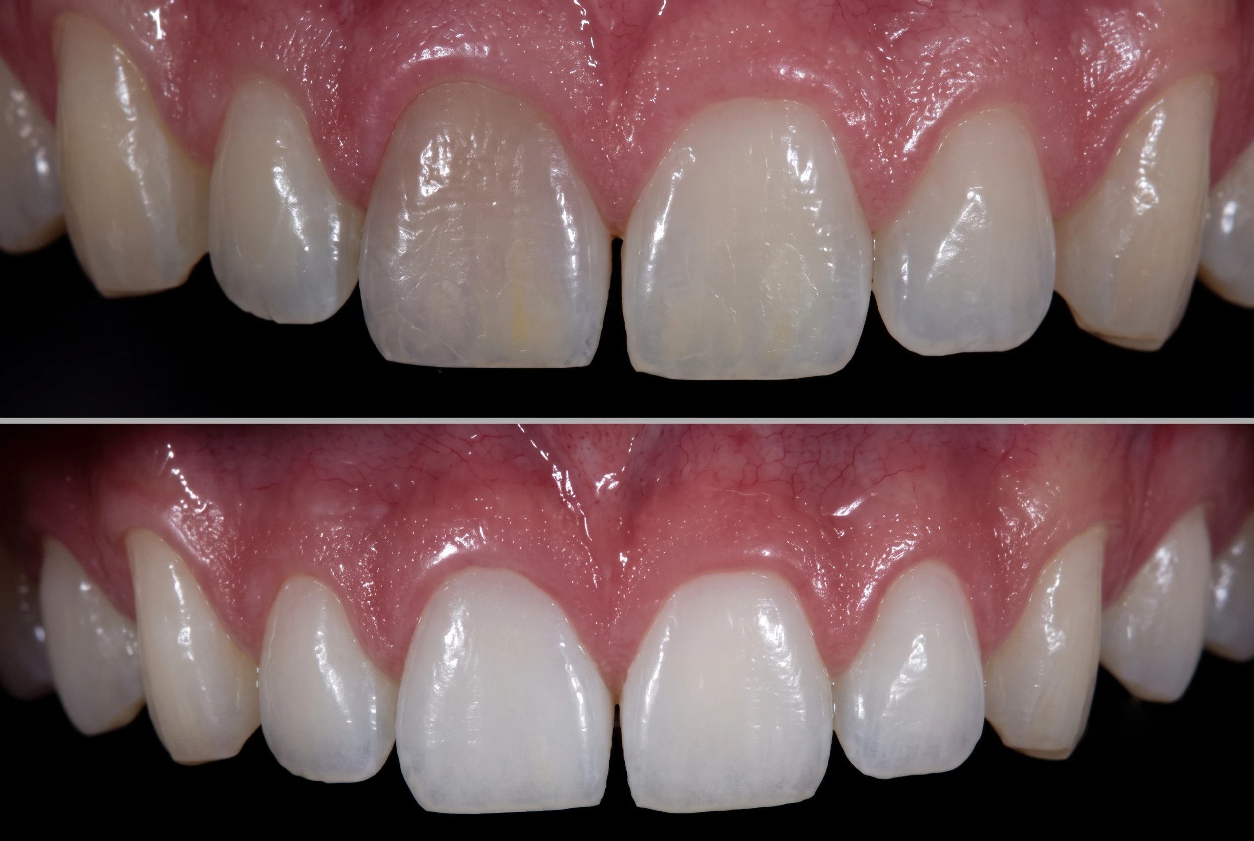 Confronto prima e dopo di un trattamento di sbiancamento dentale che mostra denti con macchie giallastre prima e un sorriso bianco e luminoso dopo.