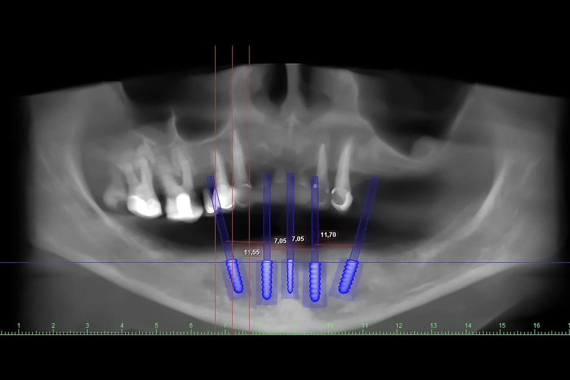 Radiografia panoramica con simulazione digitale 3D dell'inserimento e delle misurazioni di cinque impianti dentali nella mandibola.